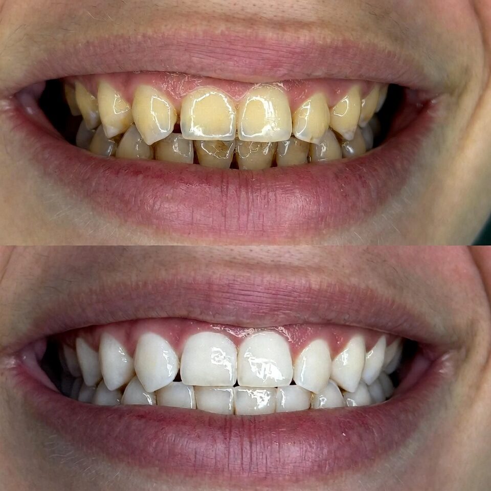 teeth whitening after before parisan beauty