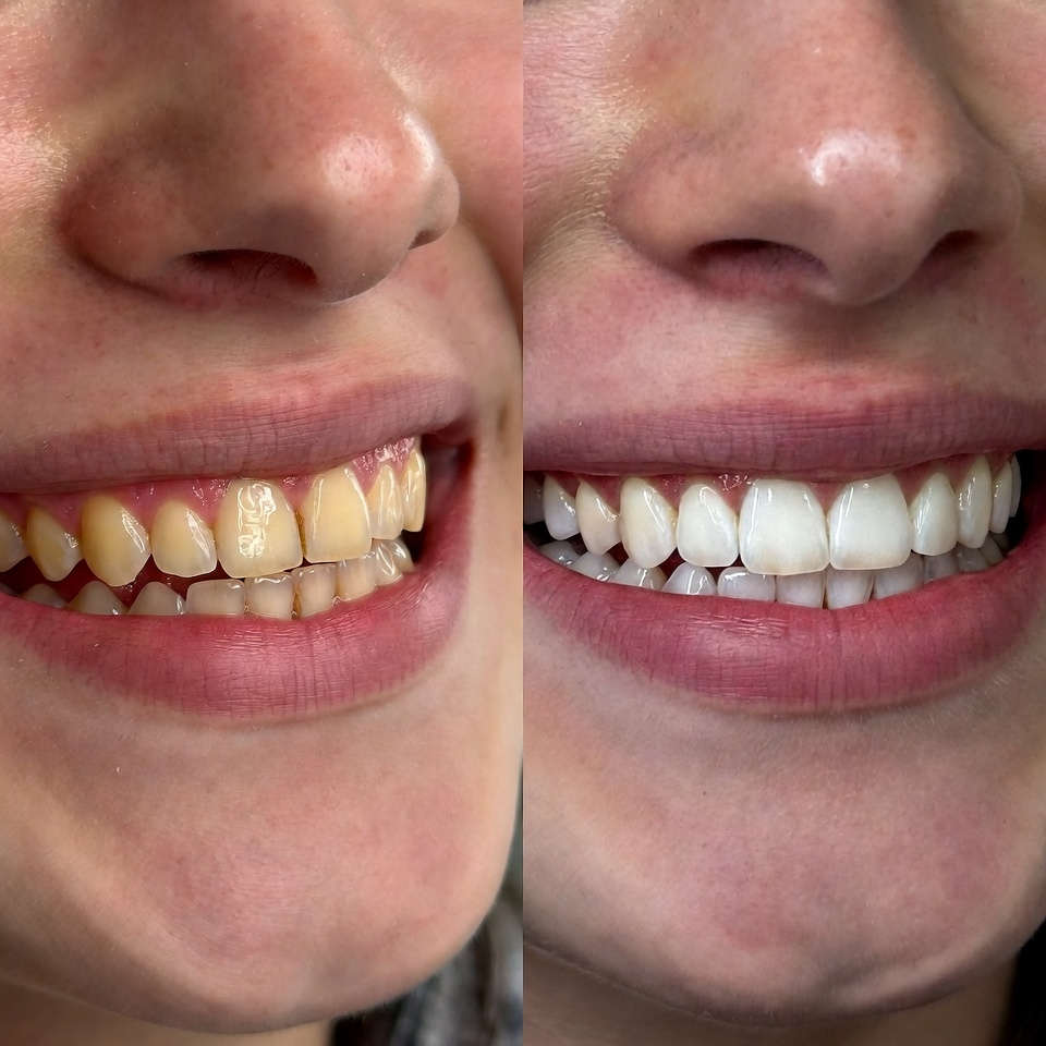 teeth whitening after before parisanbeauty